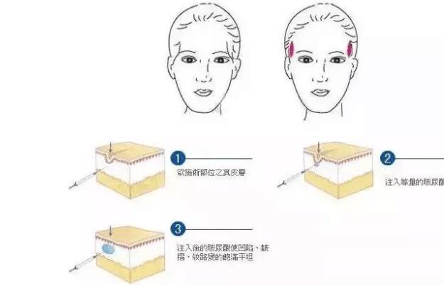 脂肪填充太阳穴亲身经历的分享！填充后15天果图来袭！