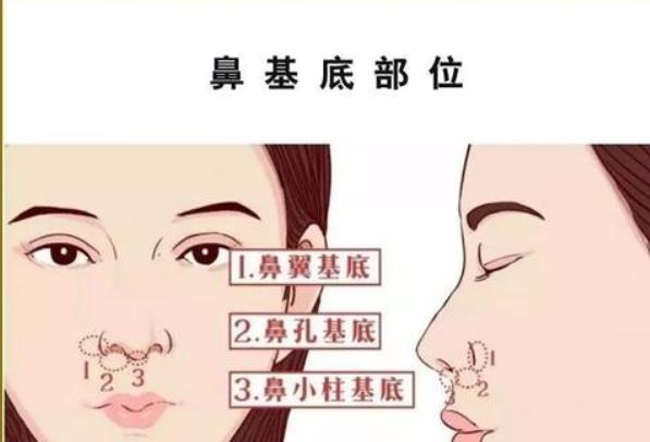 垫鼻子多少钱？做垫鼻子手术需要注意什么？价格很高吗？