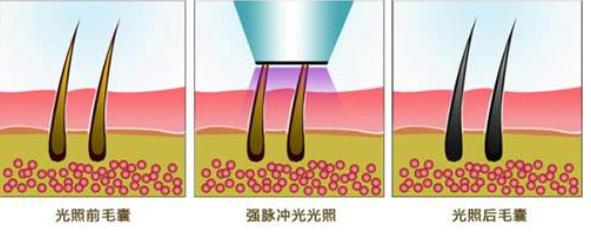 冰点脱毛价格一般多少钱？冰点脱毛优势介绍！果是的吗？