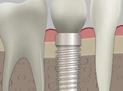 石家庄种植牙价格是多少？修复、种植牙必看！教你们闭坑！