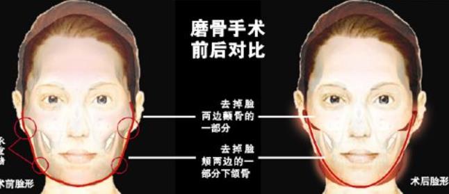 磨骨手术价位一般在多少？哪些因素会影响磨骨的价格呢？看详情！