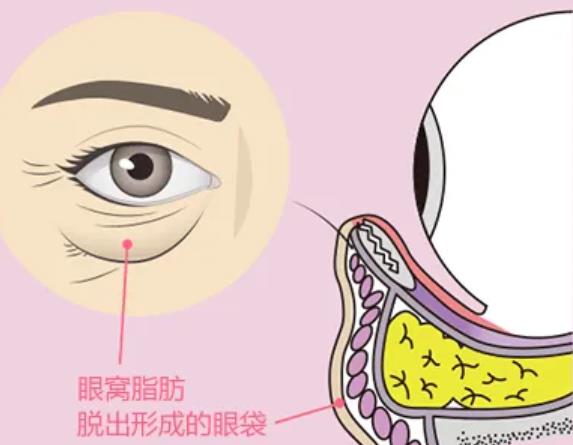 眼袋切除术需要多少钱？哪些因素会影响眼袋手术的价格？