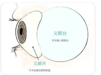 植入义眼需要多少钱呢？什么是植入义眼手术？术后怎样护理？