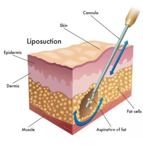 吸脂手术价格是多少？哪些因素会影响吸脂手术的费用！有价格参考