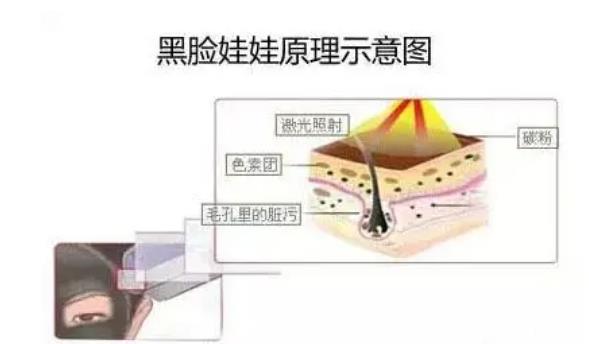 做黑脸娃娃的副作用有哪些？黑脸娃娃嫩肤原理是什么？