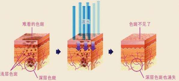 背上长痘痘什么原因导致的？来看看有哪些原因吧！