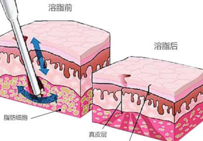 光纤溶脂瘦脸的果可以维持多长时间？注意事项分享！