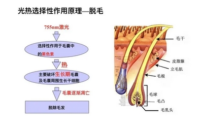 半导体激光脱毛如何？看看脱毛方式有哪些？附注意事项汇总！