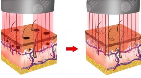 广州激光祛斑多少钱？激光祛斑的原理是什么？注意事项有哪些？