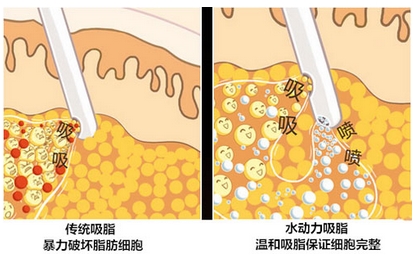 徐州医院整形美容科水动力吸脂瘦身怎么样？医生详细资料介绍！存好钱准备去做了~