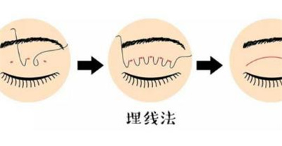 埋线双眼皮一到7天图片，看上去是不是特别自然呢？