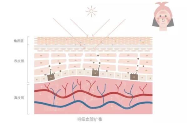 调节面部红血丝方法有哪些？光子嫩肤去红血丝的原理及优势介绍！