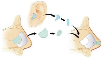 硅胶隆鼻的副作用有哪些？隆鼻手术出现副作用和后遗症怎么办?
