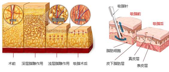 顾云鹏吸脂手术费用价格表一览，附医生简介、网友大腿吸脂案例反馈