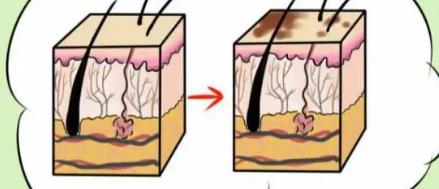 老年斑是怎样形成的？有了斑点以后改怎么办？有什么方法