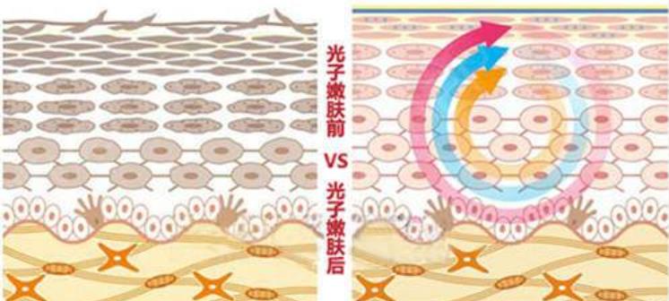 定期做光子嫩肤有什么作用？可以改良哪些问题呢？