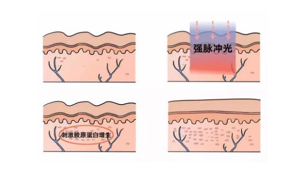 收缩毛孔的较佳方法有哪些？控油洗面奶、果酸焕肤、光子嫩肤等！