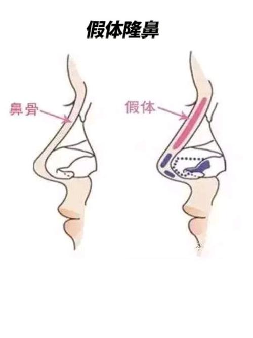 深圳艺星文丰做鼻子怎样？医生实力口碑_近期案例图分享！