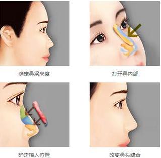 中国医学科学院整形医院位置在哪？口碑实力&坐诊专家&隆鼻案例一览