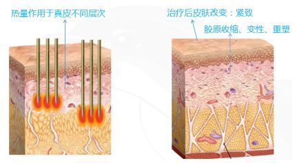 八大处做热玛吉多少钱？挂什么科？价格表2023明细&网友体验日记分享！