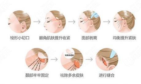 颞部拉皮手术对比照片图:前后变化是真的大！你觉的成功了吗~