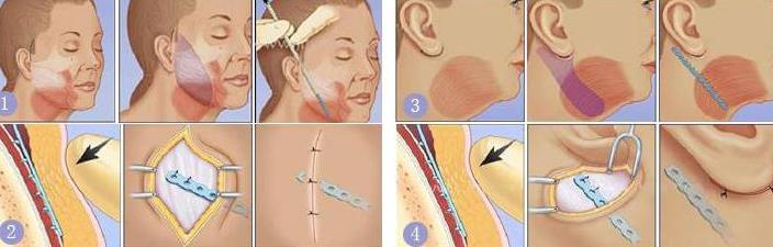 大拉皮手术后遗症有哪些？恢复期要1-2周？