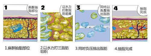 抽脂手术对身体有什么副作用？出血、神经麻痹等，80%的人不知道！