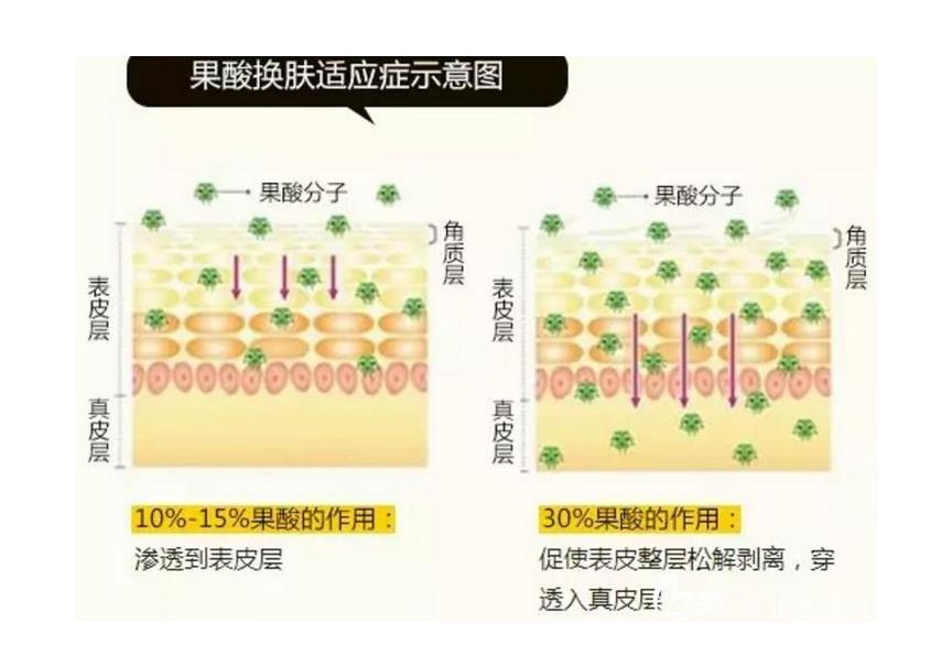 果酸换肤前后对比照片分享！皮肤细腻有光泽~