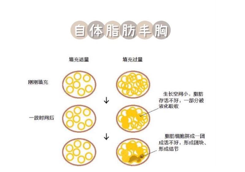 刘光晶自体脂肪隆胸案例一览:柔软酥胸超自然！附价格~