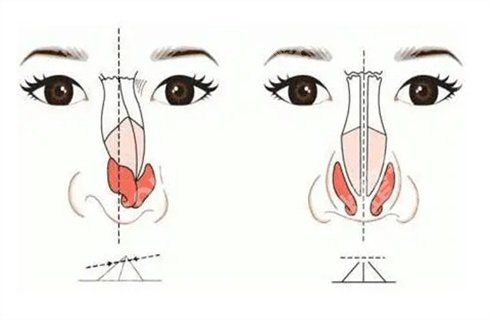 首尔丽格李哲权做鼻子怎么样？隆鼻案例在线看，隆鼻价格