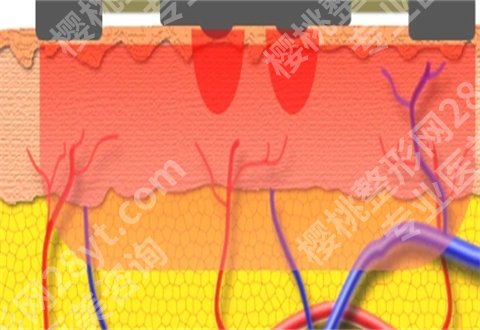 深蓝射频做一次有效果吗？弊端多不多？集合多个解答，点进看内容吧！
