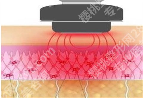 深蓝射频做一次有效果吗？弊端多不多？集合多个解答，点进看内容吧！
