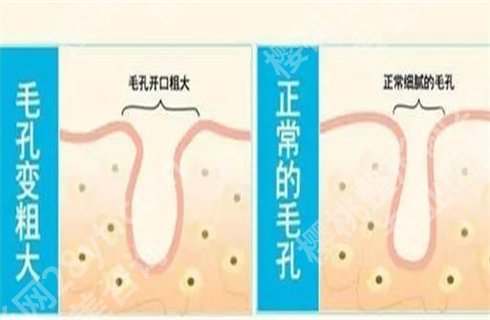 毛孔粗大怎么办？小妙招解答，一篇文章了解详情！