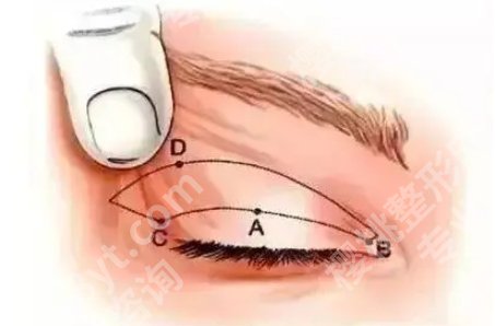 做眼部提拉手术能维持多久？手术后要注意哪些事情？价格表