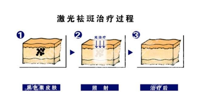 老年斑消除好的方法有哪些？激光好还是冷冻好？