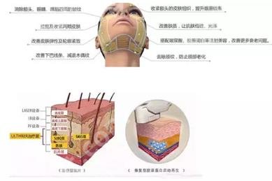 热玛吉的功效作用及副作用有什么？要注意哪些呢?