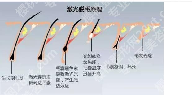 激光脱腋毛可以永久去除吗？优势、弊端等在线分析！