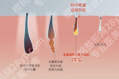 激光脱腋毛可以永久去除吗？优势、弊端等在线分析！