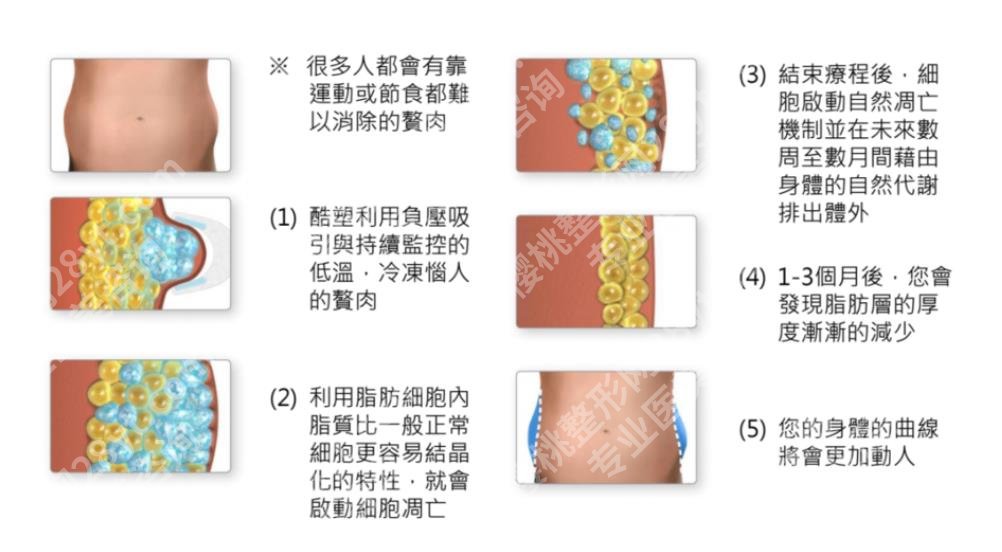 酷塑冷冻溶脂要做多少次？有危害吗？可以瘦多少？