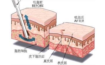 酷塑冷冻溶脂要做多少次？有危害吗？可以瘦多少？