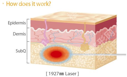 酷塑冷冻溶脂要做多少次？有危害吗？可以瘦多少？