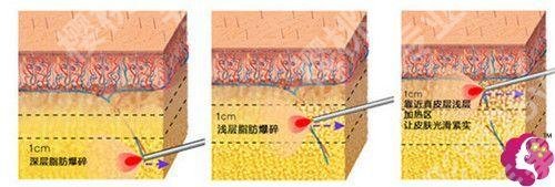 酷塑冷冻溶脂要做多少次？有危害吗？可以瘦多少？