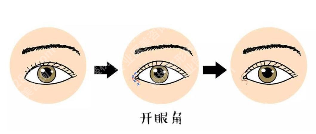 厦门中医院眼部整形怎么样？卢艺朴医生简介\开眼角案例\手术费用