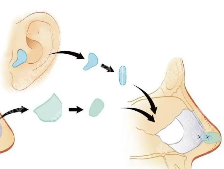 自体软骨隆鼻要多少钱？价格一般在17100元-55600元不等！