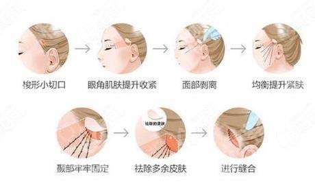 辽宁省人民医院拉皮除皱多少钱？电波拉皮8k元起\小拉皮1.1w元起！