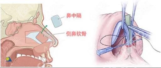 北京八大处医疗美容医院是公立吗？怎么样？口碑资料、肋骨隆鼻案例