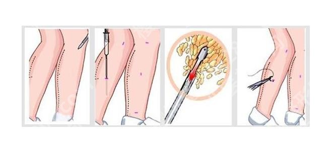 杨娴娴打瘦腿怎么样？医生技术特色、真人案例、价格表等公布！