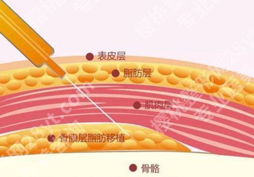 魏皎脂肪填充案例内容公开!医生优势及特色项目分享