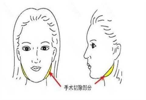 重庆铜雀台做磨骨怎么样？资质有吗？案例助攻大家看