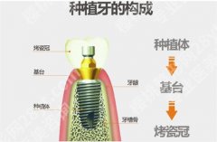 北京康贝佳口腔种牙价格？一文介绍医院详情